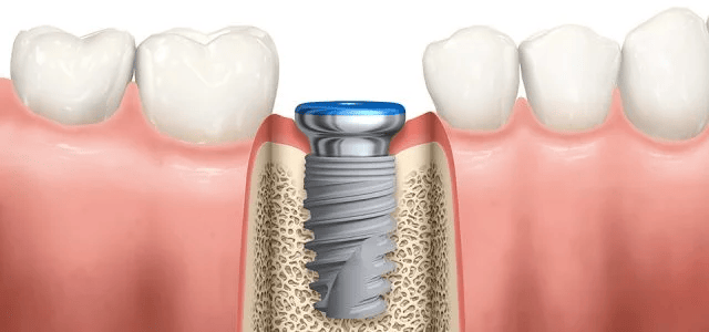 Implantes dentales: la mejor solución para la pérdida de dientes y recuperar tu sonrisa